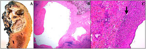 A) Pieza de hepatectomía derecha con identificación de lesión de aspecto multiquístico con cavidades entre 0,3-4cm de diámetro con abundante contenido hemático en su interior, que se encuentra inmediatamente proximal a la VSHD. B) Múltiples quistes revestidos de epitelio biliar cilíndrico o cuboideo sin atipia, con áreas de hemorragia en la periferia. Tinción HE. Magnificación 10×. C) Quistes revestidos de epitelio biliar cuboideo sin atipia y tejido hepático interpuesto (flecha). No se observa estroma de tipo ovárico en la lámina propia de ninguno de los quistes. Tinción HE. Magnificación 10×.