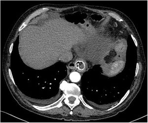 Imagen de TC del reingreso: corte axial donde se visualiza esófago conteniendo prótesis en su interior a nivel de tórax inferior, sin visualizarse sangrado activo.