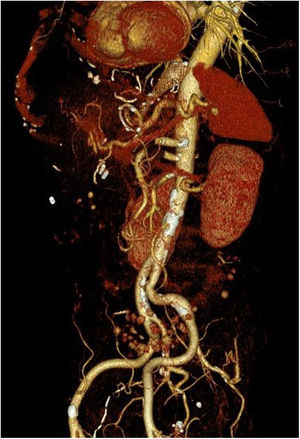 Reconstrucción 3D de la angio-TC que muestra la proximidad de la endoprótesis y la pared aórtica.