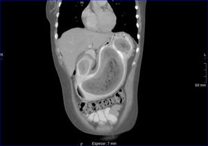 TAC de abdomen, proyección coronal.
