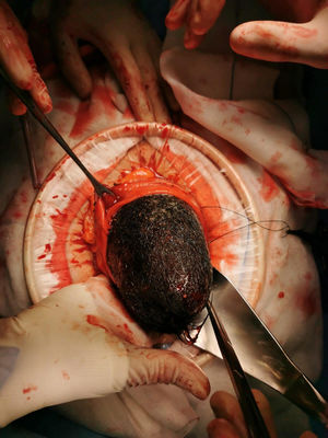 Extracción de bezoar a través de gastrotomía.