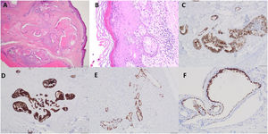 Imágenes del estudio anatomopatológico. A) Carcinoma ductal «in situ» en relación a epidermis con formación de cribas, y necrosis tipo comedo (tinción hematoxilina-eosína (H-E), x2). B) Carcinoma ductal «in situ» con presencia de extensión pagetoide. (H-E, x20).C) Tinción immunohistoquímica para CK20 resultó positiva (x10). D) Tinción immunohistoquímica para CK7 resultó positiva (x4). E) Tinción immunohistoquímica para receptor de estrogenos resultó positiva. (x10). F) Tinción immunohistoquímica para receptor de progesterona resultó positiva. (x20).