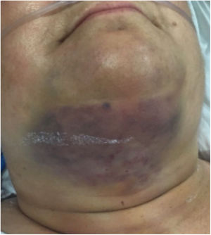 Hematoma cervical superficial (sangrado de trócar).