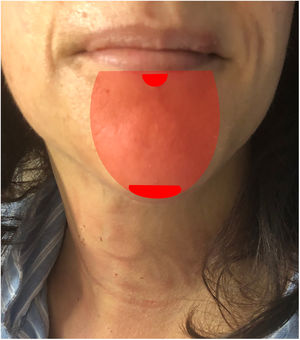 Anestesia transitoria de la región mentoniana. En sombreado, el área inicial, y en oscuro, las 2 zonas más duraderas (la línea media del labio inferior y la punta del mentón).
