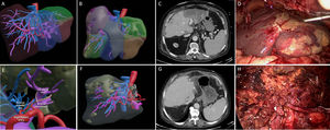 Planificación quirúrgica preoperatoria de reconstrucción virtual 3D (a). Reconstrucción virtual 3D de la isquemia hepática (b). Tomografía computarizada tras trasplante de hígado con isquemia del lóbulo hepático izquierdo y signos de necrosis en los segmentos 2-3 (c). Hallazgos intraoperatorios (d). Reconstrucción virtual 3D de trombosis de la arteria hepática izquierda y rama de la sección 4 (e). Reconstrucción virtual 3D del injerto tras resección hepática laparoscópica (f). Tomografía computarizada en el quinto día postoperatorio después de la resección hepática laparoscópica. El injerto presenta una adecuada perfusión con una pequeña región de hipoperfusión en la proximidad del margen de resección (g). Hallazgo intraoperatorio del injerto hepático tras la hepatectomía laparoscópica (h).