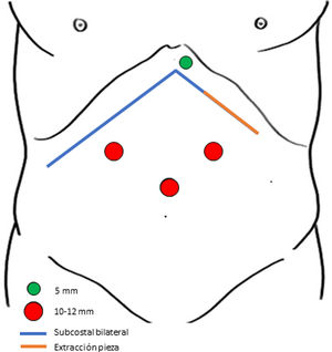 Esquema representativo de la incisión subcostal bilateral (línea azul) utilizada para el trasplante. La pieza se extrajo por el margen lateral izquierdo de esta incisión (línea naranja). Representación de la colocación de los trócares.