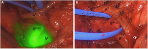 A) Visualización e identificación de la anatomía segmentaria bronquial con visión videotoracoscópica superpuesta con fluorescencia cercana al infrarrojo tras introducción del broncoscopio a través del tubo endotraqueal sin la administración de verde de indocianina. B) Vista videotoracoscópica estándar tras la disección del bronquio B9+10.