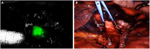 A) Visualización e identificación del bronquio segmentario B4+5 con el sistema Firefly del robot da Vinci® tras introducción del broncoscopio a través del tubo endotraqueal sin la administración de colorante fluorescente. B) Vista endoscópica tras la disección del bronquio B4+5.