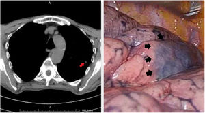 In this case, CT-guided methylene blue staining techniques was used for the GGO located in the left upper lobe (arrow). A wide wedge resection including the blue stained area (arrows) was performed.