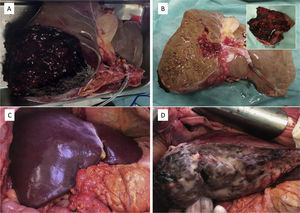 A) Aspecto del injerto después de la extracción; B) aspecto del injerto tras la reducción en banco; C) aspecto del injerto después de la reperfusión (cara anterior); D) aspecto del injerto después de la reperfusión (cara posterior).