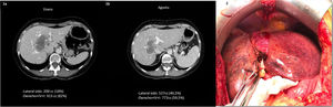 1) Evolución tras tratamiento neoadyuvante. 1a) Fase venosa del TAC inicial, previo al tratamiento: gran masa hipodensa en disposición central en contacto directo con la vena hepática media. 1b) TAC postembolización: importante hipertrofia contralateral (S II-III). 2) Intervención quirúrgica: atrofia hepática derecha e hipertrofia contralateral, de los segmentos II-III.