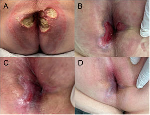 Úlceras perianales en la primera consulta (A), 4 (B), 6 (C) y 8 (D) semanas una vez suspendido el tratamiento con crema antihemorroidal.