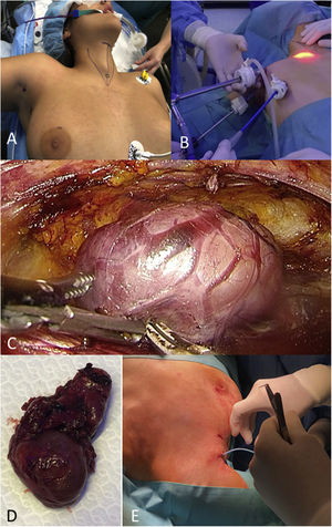 A: Posición del paciente y referencias anatómicas. B: Posición de los trócares. C: Espacio quirúrgico intraoperatorio y visualización de estructuras tiroideas. D: Extracción de la pieza quirúrgica. E: Colocación del drenaje quirúrgico.