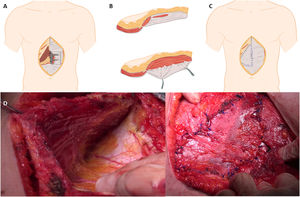 A) Detalle de la extracción de la vaina posterior del recto. B) Ampliación de la disección en la vaina posterior del recto para extracción del flap. C) Implante del flap en el defecto superior. D) Disección en la paciente de la vaina posterior del recto. E) Reimplante de la vaina posterior en el defecto.