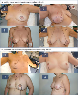 A: Tipos de mastectomías preservadoras de piel (MPP) utilizadas durante el estudio: huso periareolar (1), huso central (2), bolsa de tabaco (3), patrón en T invertida tipo 4 de Carlson (4). B: Tipos de mastectomías preservadoras de piel y pezón (MPPP) utilizadas durante el estudio: incisión inframamaria (1), vertical inferior (2), patrón vertical (3), lateral (4).