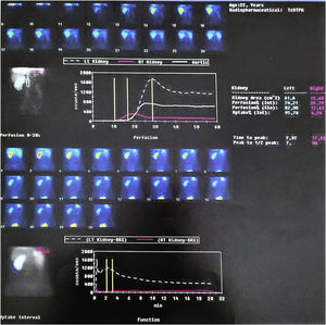Renal scintigraphy. Functional abolition of right kidney.