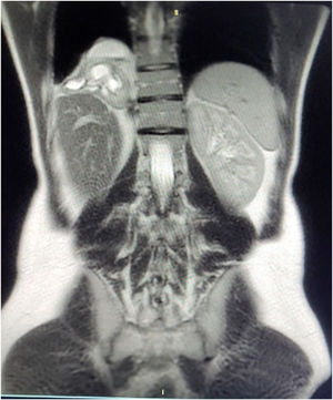 MRI: right diaphragmatic defect. Intrathoracic grade III–IV hydronephrotic right kidney due to ureteral involvement at the hernial orifice.