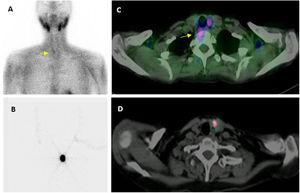Imagen preoperatoria. Localización con MIBI: adquisición planar (A) en que se intuye un pequeño adenoma inferior derecho (flecha), que la imagen de fusión SPECT/TC (C) confirma y localiza en situación ectópica, prevertebral derecha. Localización preoperatoria de adenoma paratiroideo inferior izquierdo mediante técnica ROLL: imágenes planar (B) y transaxial de SPECT/TC (D), tras la administración intralesional de MAA.