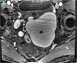 RMN pélvica en corte axial con secuencia LAVA. Se visualizan el recto (flecha) y la variz rectal adyacente (asterisco).