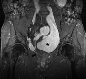RMN pélvica en corte coronal con secuencia LAVA. Se visualizan el recto colapsado (flecha) y variz rectal adyacente (asterisco).