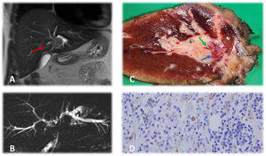 A) Estudio de resonancia magnética hepática en el que podemos observar masa de aspecto neoplásico (flecha roja) a nivel perihiliar que infiltra conducto hepático izquierdo, produciendo dilatación del mismo. B) Colangiografía por resonancia magnética nuclear en la que se aprecia marcada dilatación de vía biliar intrahepática izquierda y, en menor grado, de la vía biliar derecha. Destaca la presencia de silencio radiológico a nivel de bifurcación de ambos conductos hepáticos secundario a la masa tumoral. Conducto colédoco de calibre normal. C) Corte macroscópico de pieza de hepatectomía. Se aprecia lesión de 2,3×1,9cm (flecha azul) que rodea parcialmente a conducto biliar (flecha verde) con reacción inflamatoria circundante. D) Corte microscópico de pieza de hepatectomía. La tumoración está formada, en su mayor parte, por un estroma laxo con células epitelioides con nucléolo evidente y áreas de distribución más fasciculada. Ambas zonas presentan infiltrado inflamatorio compuesto de linfocitos, eosinófilos y células plasmáticas. Las células tumorales expresan ALK con un característico patrón de membrana nuclear, típico de este tipo tumoral.