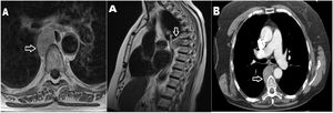 Hallazgos radiológicos de tumoración: A) Resonancia magnética con contraste de columna dorsal, corte axial y sagital: tumoración sólida (flecha blanca) bien delimitada en mediastino posterior paravertebral derecha a nivel T7-T8 sin relación con agujero de conjunción, que produce ligera remodelación del margen vertebral anterior, sin invasión ósea. B) Imagen axial de tomografía computarizada, ventana mediastino: tumoración sólida ovalada en mediastino posterior (flecha blanca).