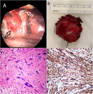 Visión macroscópica y estudio anatomopatológico. A) Visión intraoperatoria: tumoración dura (flecha negra), encapsulada, muy vascularizada con nutrición de vena ácigos (flecha blanca). B) Tumoración sólida de 4 x 3 cm, de consistencia elástica. C) En el estudio microscópico se observa una proliferación mesenquimal maligna de células fusiformes, de citoplasmas fibrilares, bordes romos, núcleos longilíneos, y otros de aspecto bizarro (Hematoxilina-Eosina, 20x). D) Se observa un inmunofenotipo tumoral de origen muscular, con expresión difusa para el marcador inmunohistoquímico Desmina (20x).