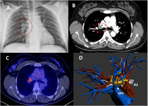 A) Rx de tórax, proyección PA con aumento de densidad hiliar derecha. B) Corte axial TC con lesión hiliar derecha englobando ramas vasculares y en contacto con bronquio principal derecho. C) Imagen de PET/TC con hipercaptación patológica en región hiliar derecha. D) Reconstrucción en 3D que muestra lesión englobando vena pulmonar superior derecha, en íntimo contacto con rama arterial mediastínica (A1) y tronco arterial (*). PA: posteroanterior; PET/TC: tomografía por emisión de positrones; Rx: radiografía; TC: tomografía computarizada.