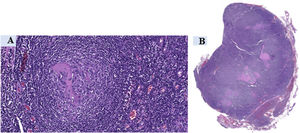 Enfermedad de Castleman, tipo hialino vascular. A) Tinción HE (20x). Folículo atrófico con expansión de la zona del manto mostrando el patrón de «capas de cebolla» y vasos hialinizados penetrantes (lollipop). B) Tinción HE (0,3x). Panorámica. Ganglio linfático aumentado con hiperplasia folicular, centros germinales atróficos hialinizados y expansión de la zona del manto. HE: hematoxilina-eosina.