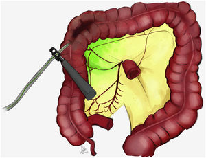 La ilustración muestra la inyección intraoperatoria peritumoral del verde indocianina.