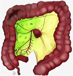 La imagen muestra la difusión del colorante que evidencia la distribución linfoganglionar propia de la lesión.