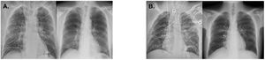 A. Chest x-rays of the first transplanted patient before extubation and at discharge. B. Chest x-rays for the second transplanted case after transplant and at discharge.