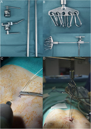 Sistema de tracción cenital esternal. A: Barras de acero y engranajes de fijación. B: Sistema rotatorio dentado unidireccional. Mosquetones. C: Sutura de acero a nivel esternal para efectuar la tracción. D: Sistema en funcionamiento. Se puede apreciar la elevación esternal resultante.