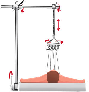 Sistema de tracción cenital esternal. Ilustración esquemática que refleja los diferentes puntos de montaje y fijación del sistema de tracción, así como el funcionamiento de este.