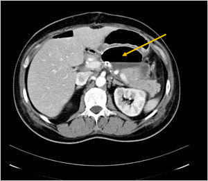 CT scan showing an infected retrogastric fluid collection (10 cm diameter) that developed 14 days after central pancreatectomy. The collection was successfully drained by endoscopic ultrasound with two Double pigtail plastic stents (8.5 and 10 french).