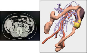 Corte axial de TC abdominopélvica y reconstrucción 3D a partir de la misma TC. 1: tumor, 2: adenopatía en territorio de vena mesentérica inferior, 3: bazo.