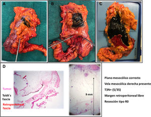 Estudio anatomopatológico de la pieza quirúrgica. A: Visión anterior con tatuaje margen tumoral por endoscopia. B: Visión posterior de la pieza quirúrgica con fascia retroperitoneal señalada por el cirujano. C: Visión posterior de la pieza quirúrgica con margen retroperitoneal pintado de negro con tinta china y fascia retroperitoneal pintada de rojo con tinta china. D: Visión microscópica de la relación del tumor con la fascia retroperitoneal y la distancia del tumor al margen retroperitoneal. 1: fascia retroperitoneal.