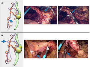 Diferentes pasos quirúrgicos del procedimiento, representados mediante imágenes de 3D-IPR y fotogramas de la intervención. A: Flecha azul: ligadura alta de arteria cólica izquierda. B: Flecha azul: ligadura de vena mesentérica inferior en borde inferior de páncreas. 1 y 2: posibles adenopatías en territorio de vena mesentérica inferior.
