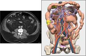 Corte axial de TC abdominopélvica y reconstrucción 3D a partir de la misma TC. 1: tumor, 2: posible infiltración de grasa retroperitoneal, 3: posibles adenopatías.