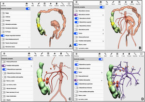 Método 3D-IPR empleado para establecer estrategia quirúrgica en neoplasia de colon derecho. A: Delimitación matemática de margen intestinal 10cm proximal y distal al tumor. B: Vasos nutrientes del área establecida en A. C: Localización de posibles adenopatías en territorio arterial del área establecida en A. D: Localización de posibles adenopatías en territorio venoso del área establecida en A.