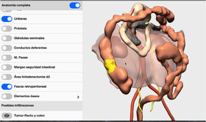 Demostración de la reconstrucción de la fascia retroperitoneal mediante 3D-IPR. 1: fascia retroperitoneal.