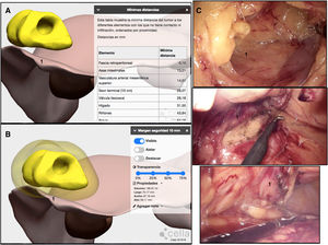 Método 3D-IPR empleado para establecer la relación del tumor con la fascia retroperitoneal y simular una pieza quirúrgica con un margen radial libre de infiltración de 1cm. Demostración de cirugía realizada mediante fotogramas. A: Distancia mínima obtenida mediante 3D-IPR del tumor a la fascia retroperitoneal: 0,1mm. B: Simulación de margen quirúrgico radial libre de infiltración de 1cm que muestra la necesidad de incorporar la fascia retroperitoneal a la pieza quirúrgica. C: Incorporación de la fascia retroperitoneal a la pieza quirúrgica. 1: fascia retroperitoneal.