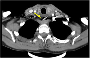 Imagen axial de TC cervico-torácico donde se identifica cuerpo extraño que atraviesa el esófago cervical alcanzando glándula tiroides.