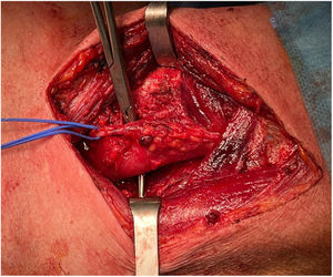 Imagen intraoperatoria de cervicotomia lateral izquierda identificándose perforación esofágica en cara anterior y posterior. Nervio laríngeo recurrente izquierdo tutorizado con vessel loop azul.