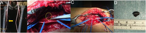 A) AngioCT: cuerpo metálico de 7,5 mm en arteria femoral superficial derecha; B) extracción del cuerpo metálico y trombectomía; C) preparación de la arteria del extremo proximal y distal; D) astilla metálica.