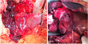 Hematoma duodenal secundario a neoplasia de cabeza de páncreas. A) Hemoperitoneo y hematoma que diseca la seromuscular duodenal, abierta en rodilla superior a cavidad. B) Aspecto tras evacuación del hematoma y previo al inicio de la duodenopancreatectomía cefálica.