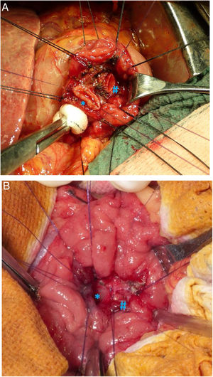 Detalle del momento de reimplantación de la vía biliar (*) y del conducto pancreático principal (#) tras realizar ampulectomía transduodenal. A) Antes de reimplantar el conducto biliar y pancreático, y B) una vez completadas las anastomosis biliar y pancreática.