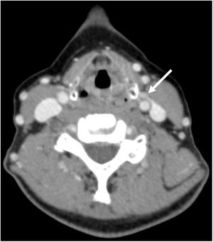 Imagen de TC-4D en fase venosa que muestra un adenoma ectópico submaxilar izquierdo entre el cartílago tiroides y la carótida común, con un pedículo a la vena yugular interna.