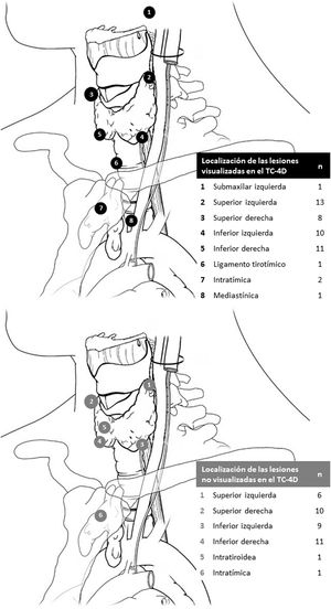 Localización y número (n) de las glándulas paratiroides patológicas localizadas (negro) y no localizadas (gris) mediante TC-4D.
