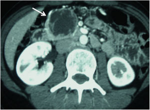 Imagen axial de TC abdominal en fase arterial que evidencia lesión compatible con TNE quístico (flecha) en proceso uncinado pancreático (caso 1).